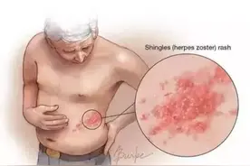 缠腰龙，钻心痛：是半夜想打滚的疼，是会呼吸的痛图片
