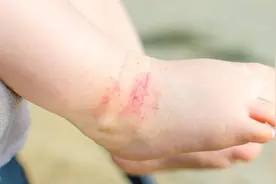 皮炎有哪些类型？图片