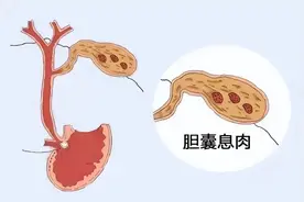 胆囊息肉是怎样的存在？为何我感觉不到它？图片