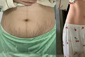 淡化妊娠纹拒交智商税！手把手教你怎么买到有用靠谱的妊娠产品！图片