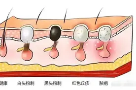 脸上老是长粉刺，这10个原因你知道吗？图片