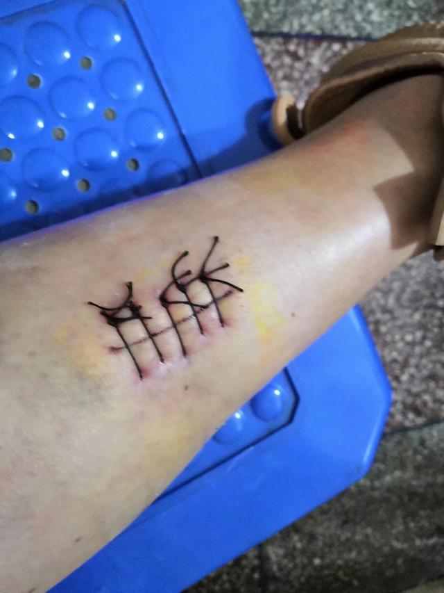 脖子以下全部瘫痪的病友叔叔说：“姑娘，我得的和你一样的病。”