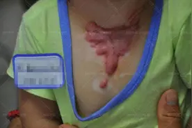 郑州疤痕医院？疤痕增生怎么治疗好？图片