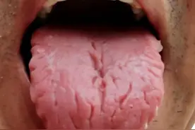 舌头有裂纹是怎么回事？又该怎样调？四种裂纹舌，教你对症解决！图片