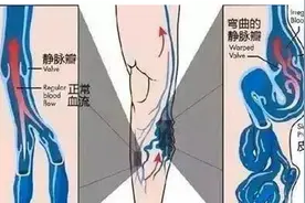 静脉曲张 手术把血管切除了会不会影响血液循环？图片