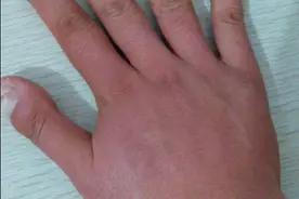 39岁女士手指变粗，一查是肺癌！手上出现这些信号，当心疾病来临图片