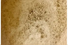 肾病综合征治得好吗？平时注意什么？图片