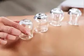 拔火罐时，后背出现的瘀血，是排出的毒素吗？真相来了图片