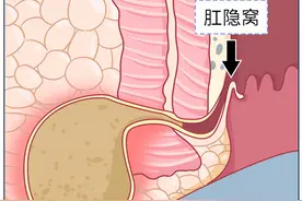 肛窦炎——多种肛门不适的“元凶”图片