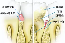 上了年纪就一定会掉牙？逃不过牙齿掉光的宿命？图片