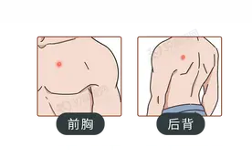 前胸后背长痘痘，是什么原因？简单来讲，可能是没做好这3件事图片
