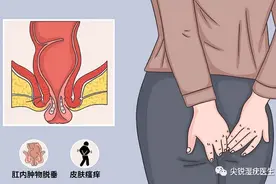 肛周尖锐湿疣怎么判断图片