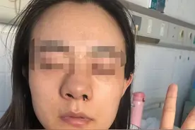 病号服全部被冷汗打湿，我在搀扶下坚持去问医生鼻子有没有变塌图片