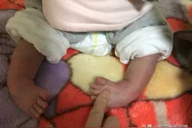 新生儿足内翻能自愈吗?图片