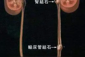 中医西医治疗输尿管结石全攻略——一个三甲医院医生亲身经历图片