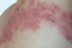 吉大一院皮肤科主任李珊山提醒：警惕！带状疱疹有特殊的临床表现图片