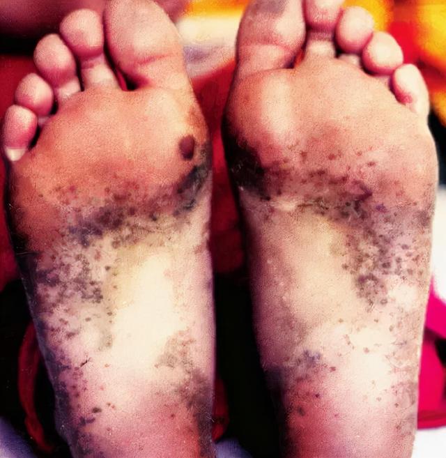 最恶心密集恐惧症图片 手掌,一个手掌拍死30多只蚊子!