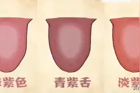 李铁红大夫：四大舌色各自代表的健康内涵是什么？图片