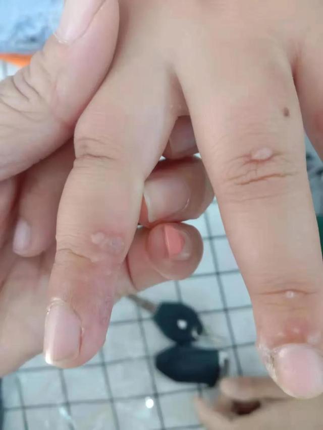 小孩手上长瘊子怎么办