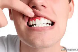「牙齿那些事儿」No.169丨为什么牙龈上会长脓包？可以用针挑掉吗图片