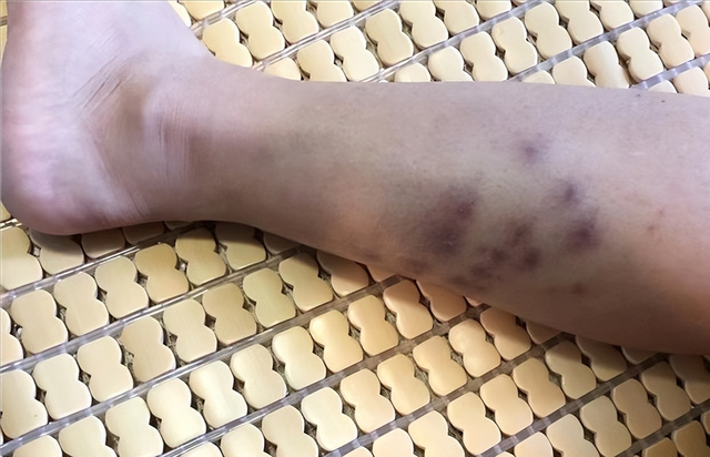 红火蚁再伤人！广西一女子被咬伤！伤势严重！被咬了该怎么办？