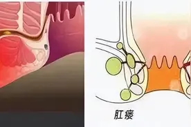 治肛瘘，中医有哪些高招？图片