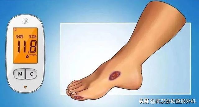 足底过度角化名词解释