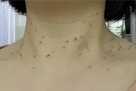 脖子上长很多丝状小肉球怎么办？医生：教你根除丝状疣和皮赘方法图片