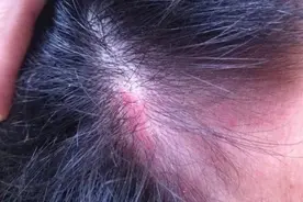 头皮里，老是长疙瘩和脓包，是怎么了？提醒：或是4种疾病警报图片