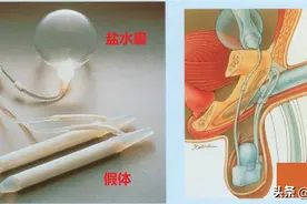 我为什么不建议正常人做阴茎假体植入手术？图片