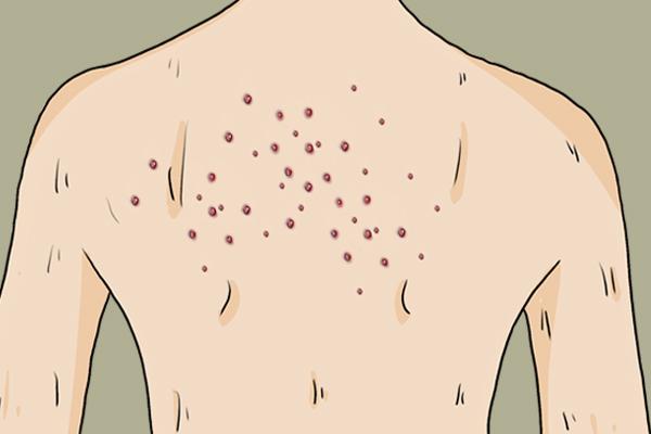 毛囊炎皮肤毛周角化症怎么治