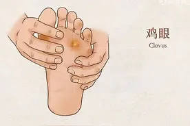 “鸡眼”到底是怎么回事？有了鸡眼应该如何正确处理？图片
