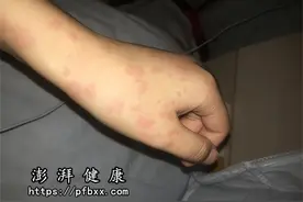 晚上身上痒一抓就红一片还凸起疙瘩，白天就好了是什么病？图片