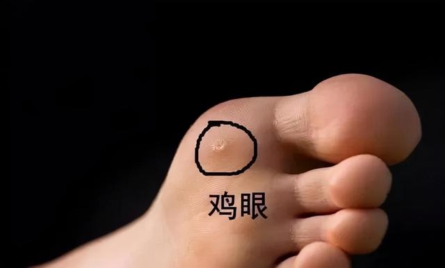 长了鸡眼怎么办，怎么治疗好？
