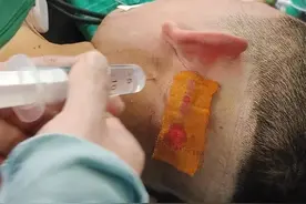 三叉神经痛，难道只能吃止疼药吗？微创手术，有可能会一劳永逸。图片