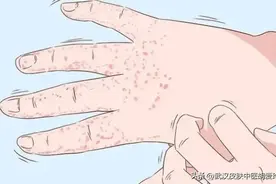 手掌又疼又痒出现红肿是什么情况怎么治疗好得快图片