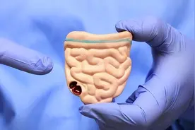 肠癌很难被人体察觉？肠癌早期有哪些信号？这些信号人人要知道图片
