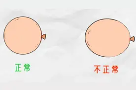 摘下眼镜像“金鱼眼”？这眼睛还有得救吗？图片