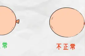 摘下眼镜像“金鱼眼”？这眼睛还有得救吗？图片