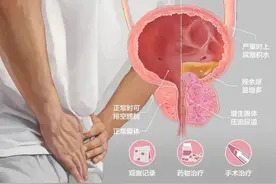大爷多年的难言之隐，医生施妙手为他解困扰图片