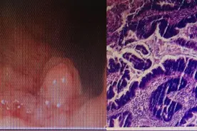 肛门摸到一个小肉赘 并非痔疮而是直肠肿瘤？图片