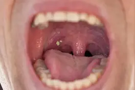 喉咙“长结石”，实在太恶心！需要定期去医院进行治疗吗？图片