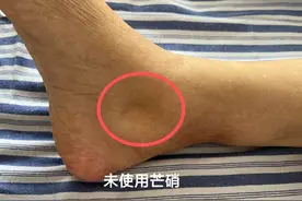 巧用芒硝治水肿图片