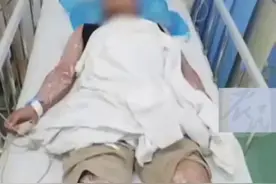 红火蚁再伤人！广东一男子被咬伤后，全身起泡倒地休克！有多毒？图片