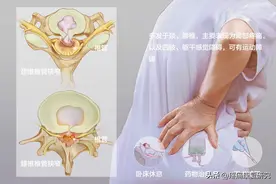 腰椎管狭窄症的病因、症状、分型、检查及诊断和治疗图片