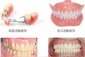 缺牙后2个结果难承受！假牙、种植牙价格相差百倍？牙医带你选图片