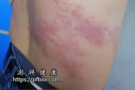 身上长有很多黄色水泡非常疼是什么原因图片