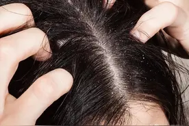 如果出现这些症状，不是你头没洗干净，而是你患上脂溢性皮炎了！图片