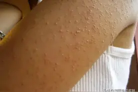 别人的皮肤光滑细腻，你的皮肤“鸡皮”密密？这份自救指南请收好图片