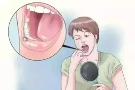 怀疑感染了口腔湿疣怎么办？图片